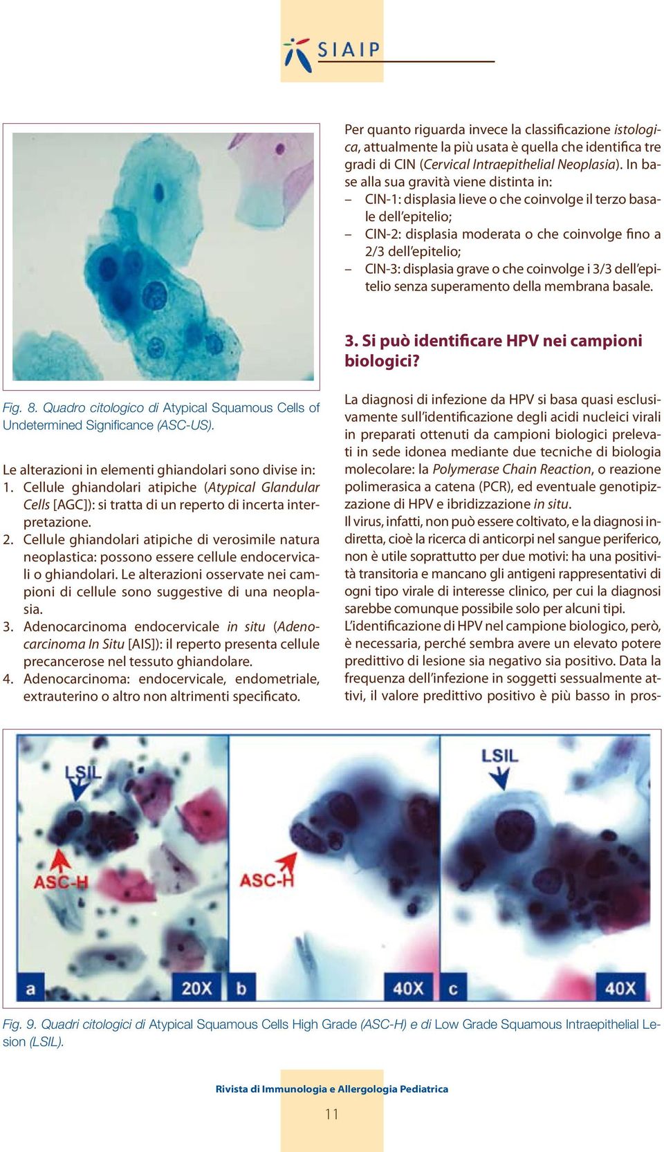 grave o che coinvolge i 3/3 dell epitelio senza superamento della membrana basale. 3. Si può identificare HPV nei campioni biologici? Fig. 8.