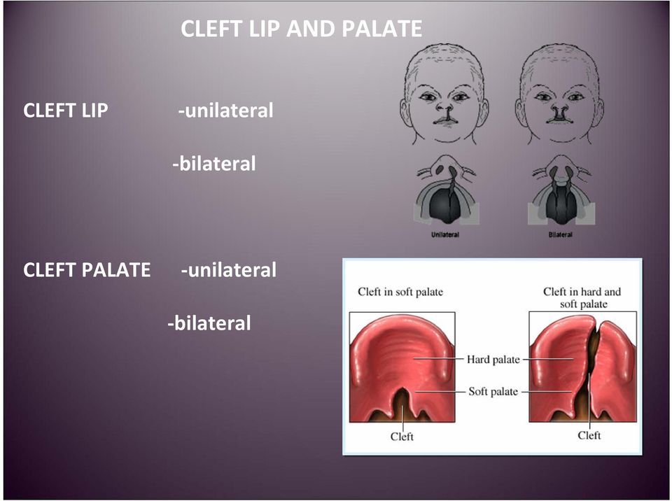 bilateral CLEFT