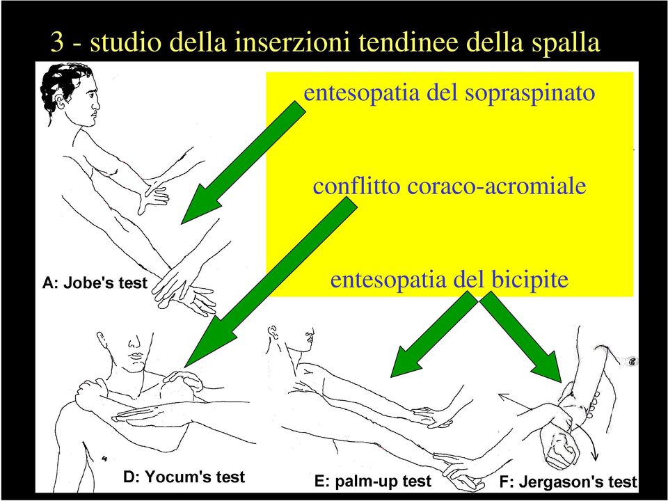 entesopatia del sopraspinato