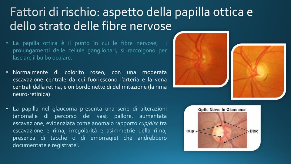 delimitazione (la rima neuro-retinica) La papilla nel glaucoma presenta una serie di alterazioni (anomalie di percorso dei vasi, pallore, aumentata