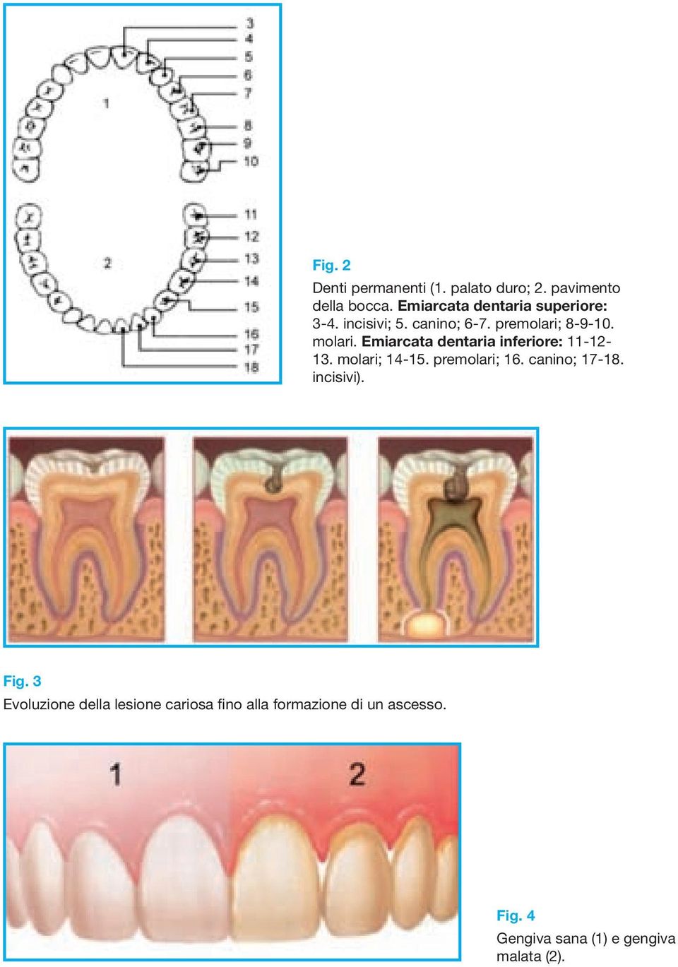 Emiarcata dentaria inferiore: 11-12- 13. molari; 14-15. premolari; 16. canino; 17-18.