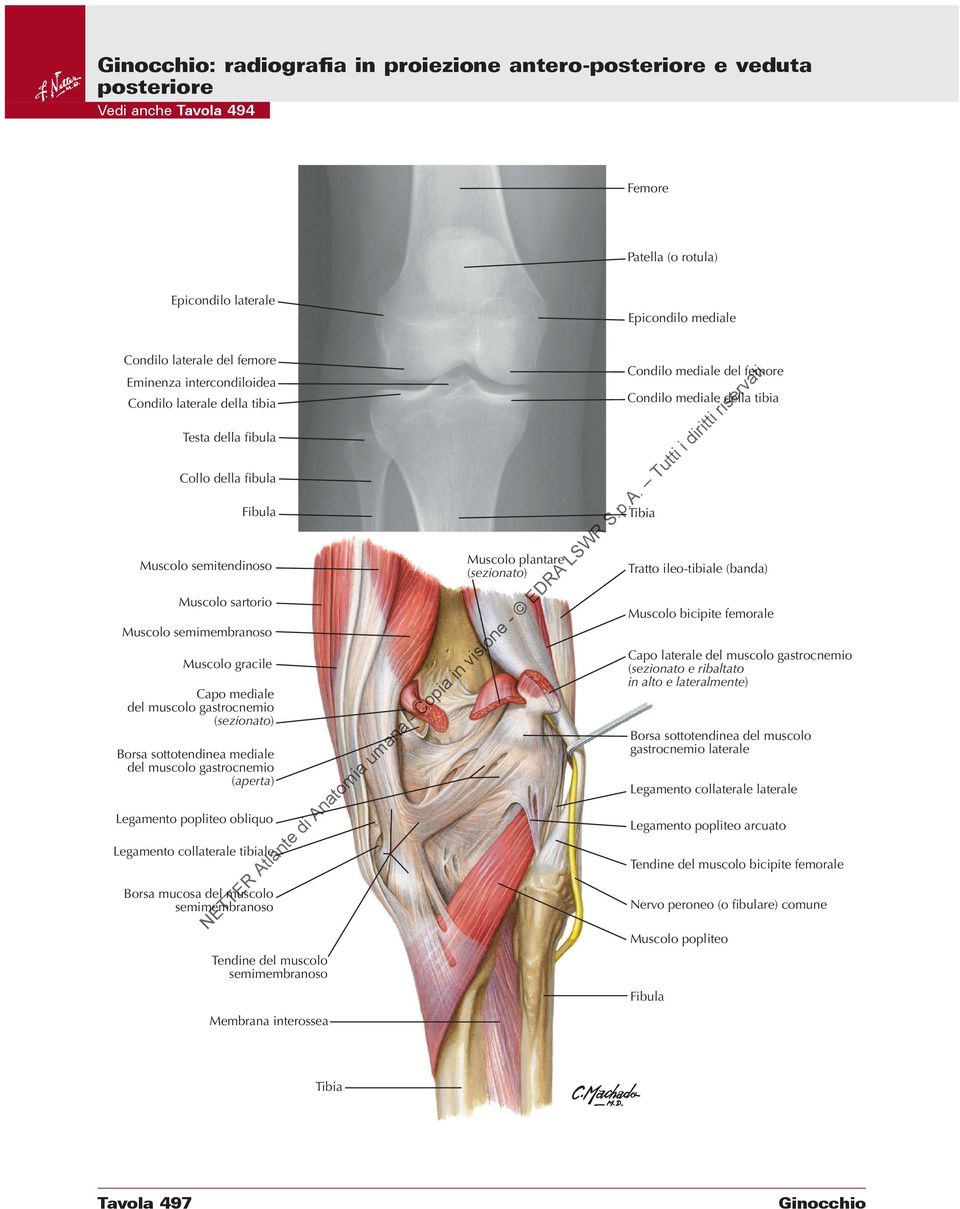 mediale del muscolo gastrocnemio (aperta) Legamento popliteo obliquo Legamento collaterale tibiale Borsa mucosa del muscolo semimembranoso Tendine del muscolo semimembranoso Membrana interossea