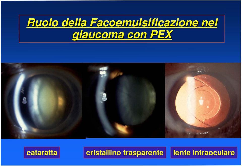 glaucoma con PEX cataratta