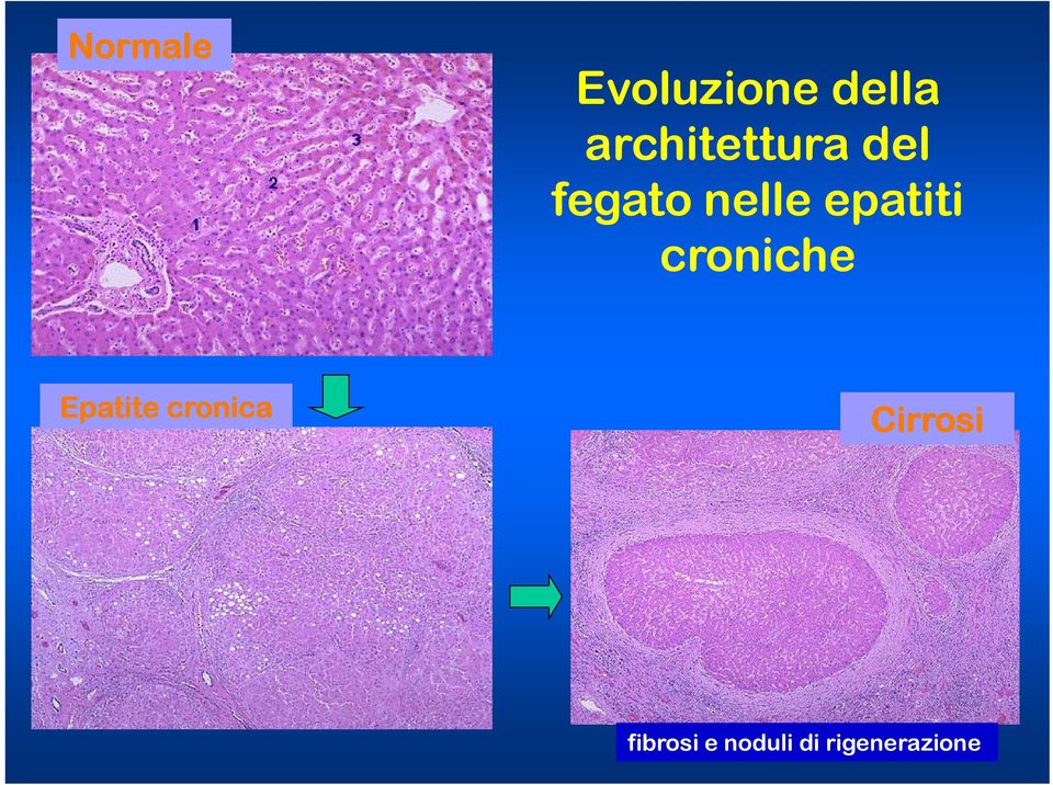 epatiti croniche Epatite cronica