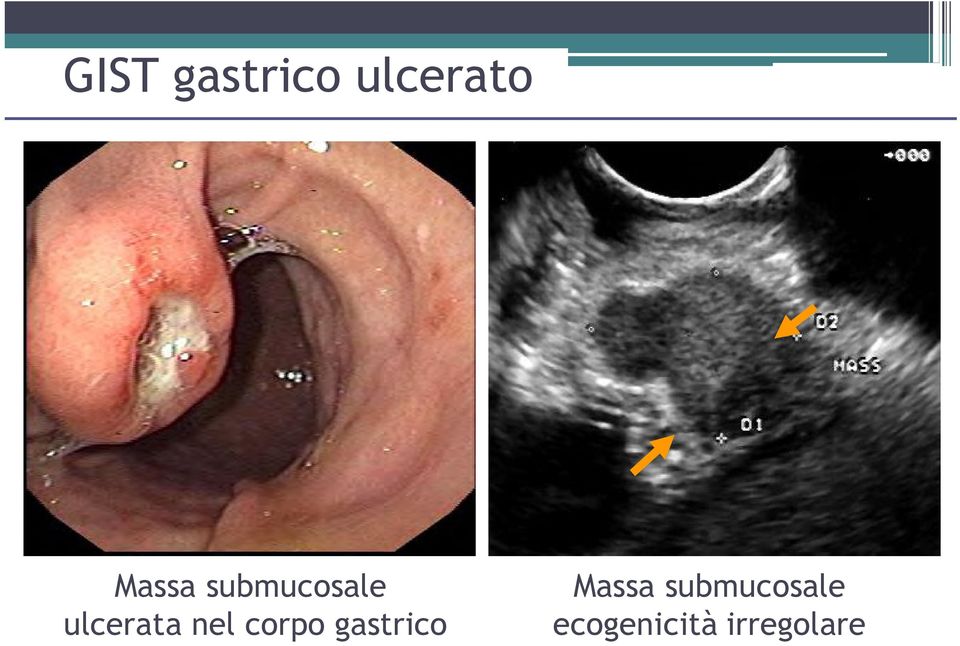 nel corpo gastrico Massa