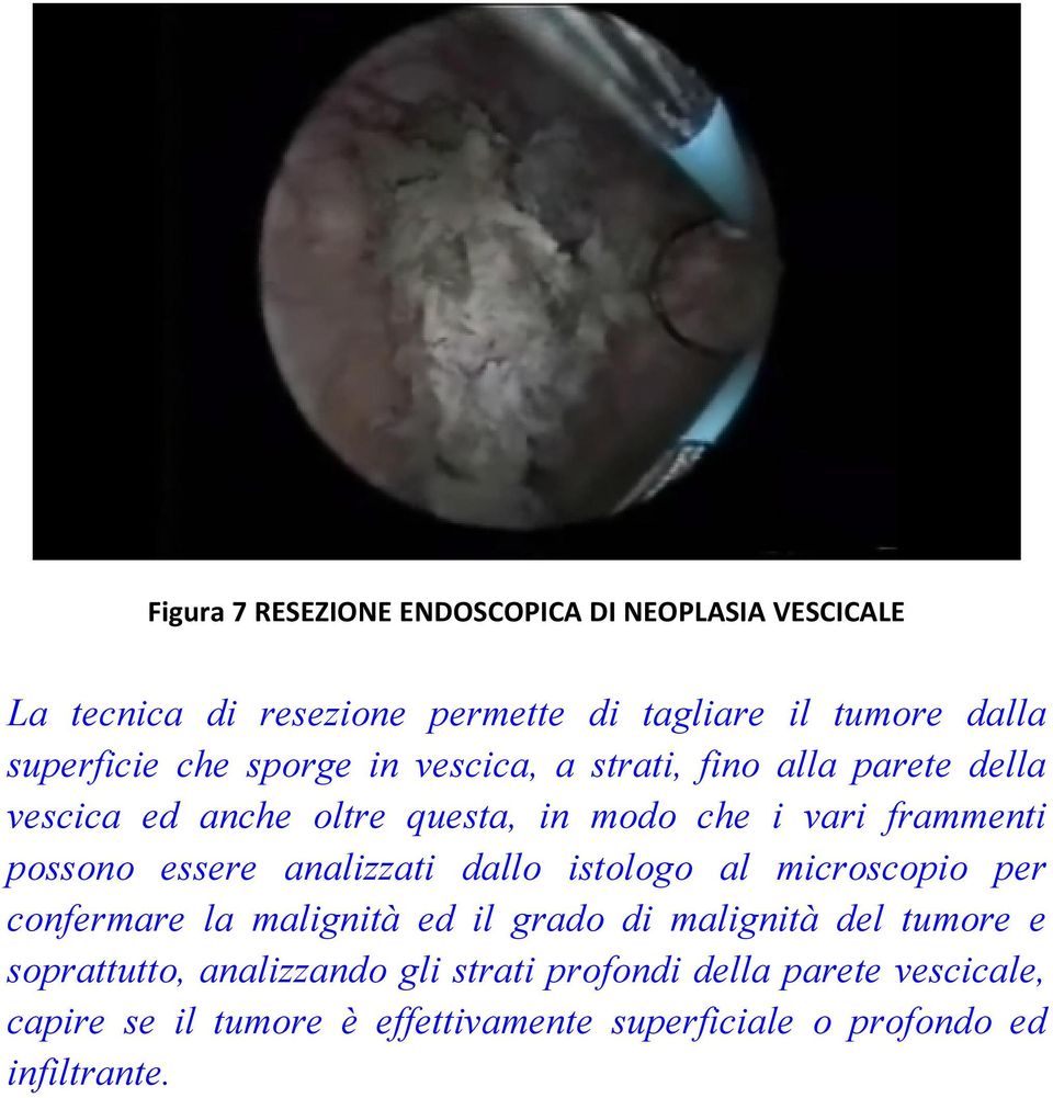 essere analizzati dallo istologo al microscopio per confermare la malignità ed il grado di malignità del tumore e soprattutto,