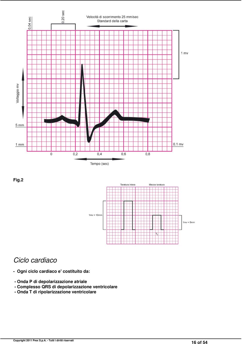 atriale - Complesso QRS di depolarizzazione