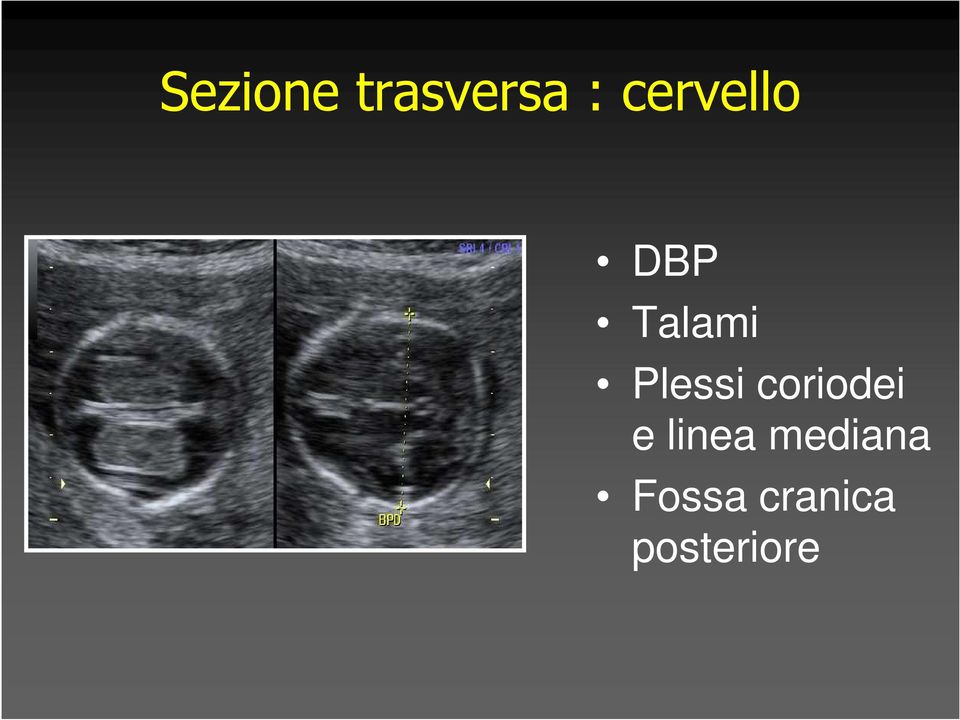 Plessi coriodei e linea