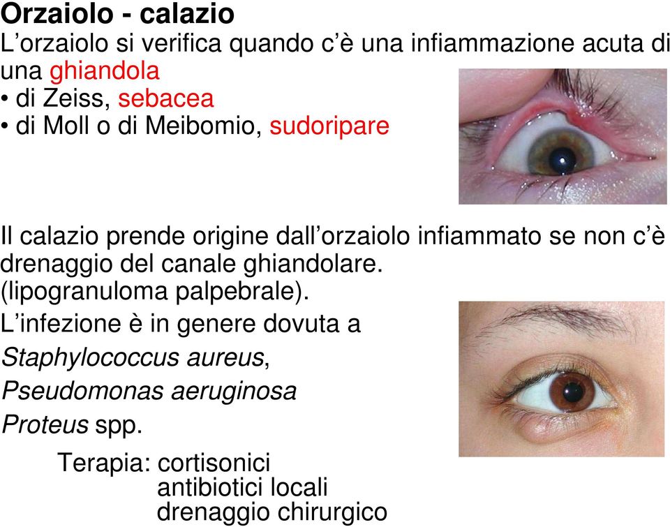 drenaggio del canale ghiandolare. (lipogranuloma palpebrale).