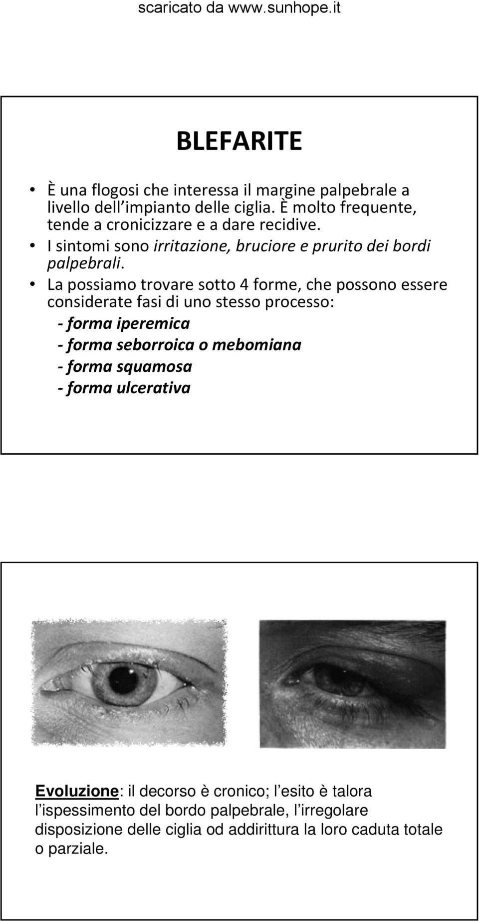 La possiamo trovare sotto 4 forme, che possono essere considerate fasi di uno stesso processo: forma iperemica forma seborroica o mebomiana