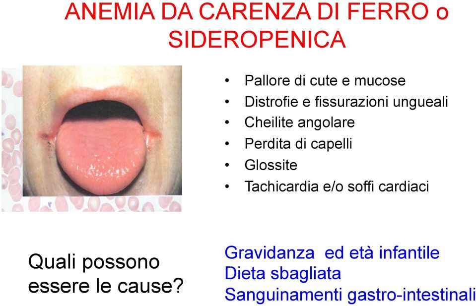 Glossite Tachicardia e/o soffi cardiaci Quali possono essere le cause?