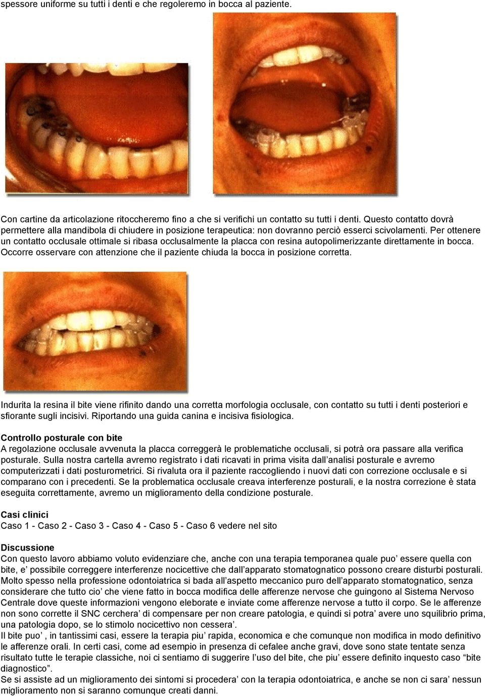 Per ottenere un contatto occlusale ottimale si ribasa occlusalmente la placca con resina autopolimerizzante direttamente in bocca.