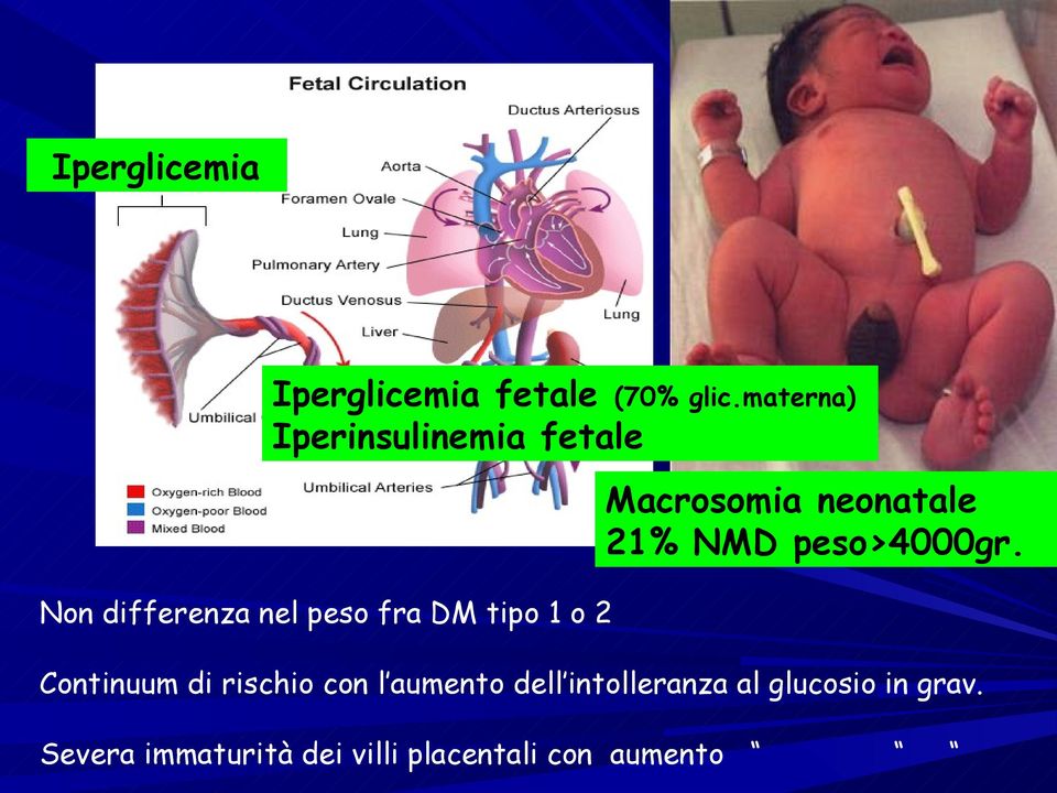 o 2 Macrosomia neonatale 21% NMD peso>4000gr.