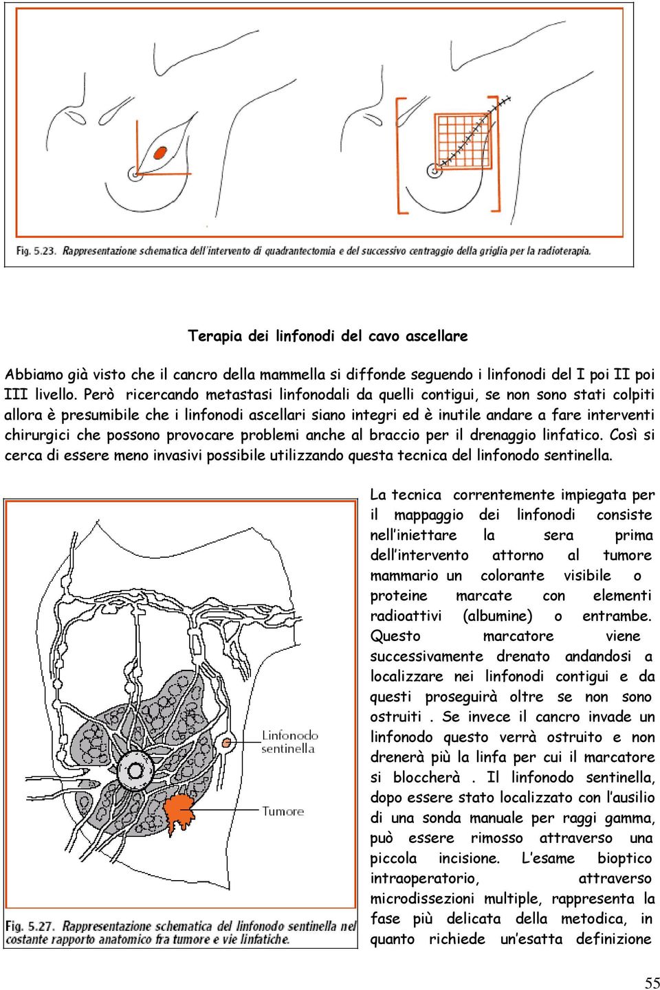 possono provocare problemi anche al braccio per il drenaggio linfatico. Così si cerca di essere meno invasivi possibile utilizzando questa tecnica del linfonodo sentinella.