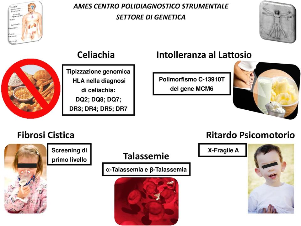 Polimorfismo C-13910T del gene MCM6 Fibrosi Cistica Ritardo