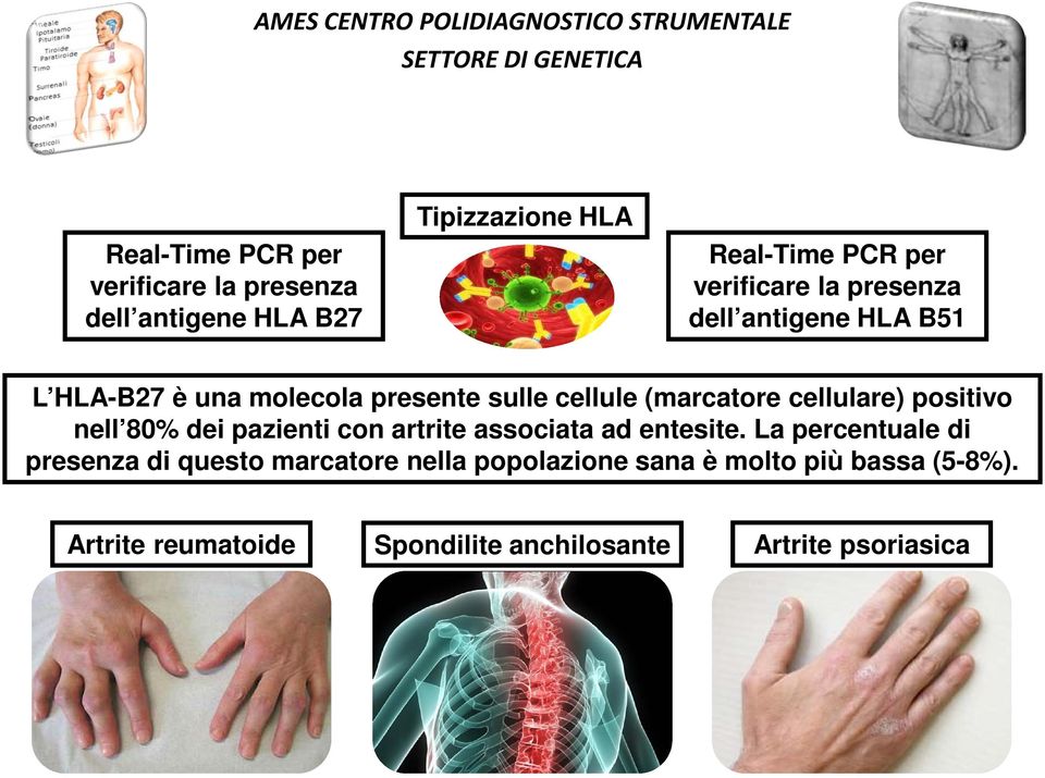 positivo nell 80% dei pazienti con artrite associata ad entesite.