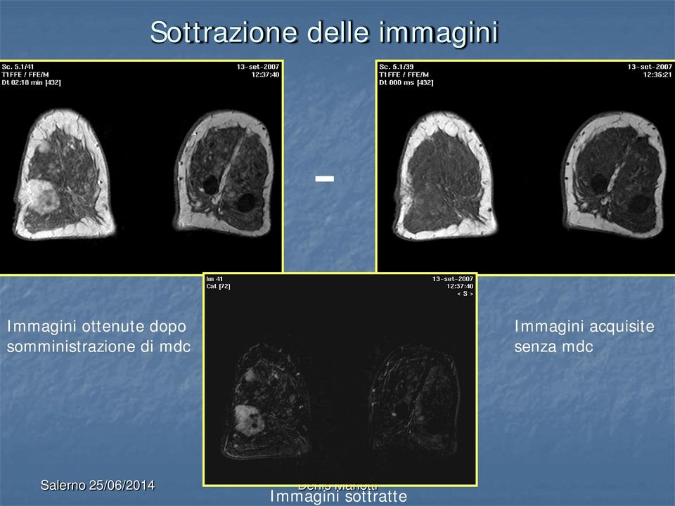 somministrazione di mdc