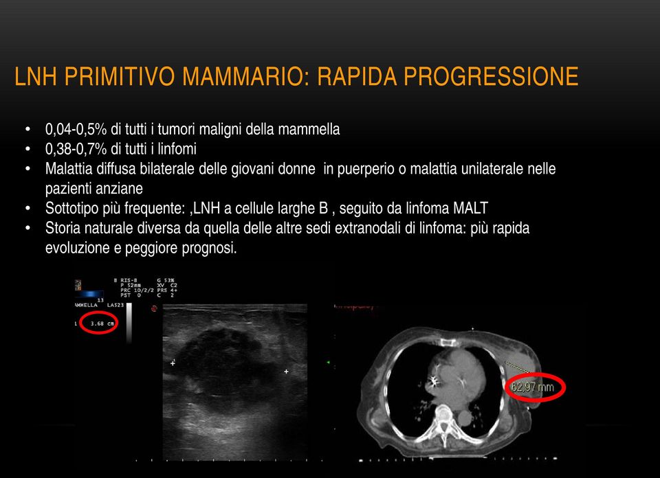 nelle pazienti anziane Sottotipo più frequente:,lnh a cellule larghe B, seguito da linfoma MALT Storia