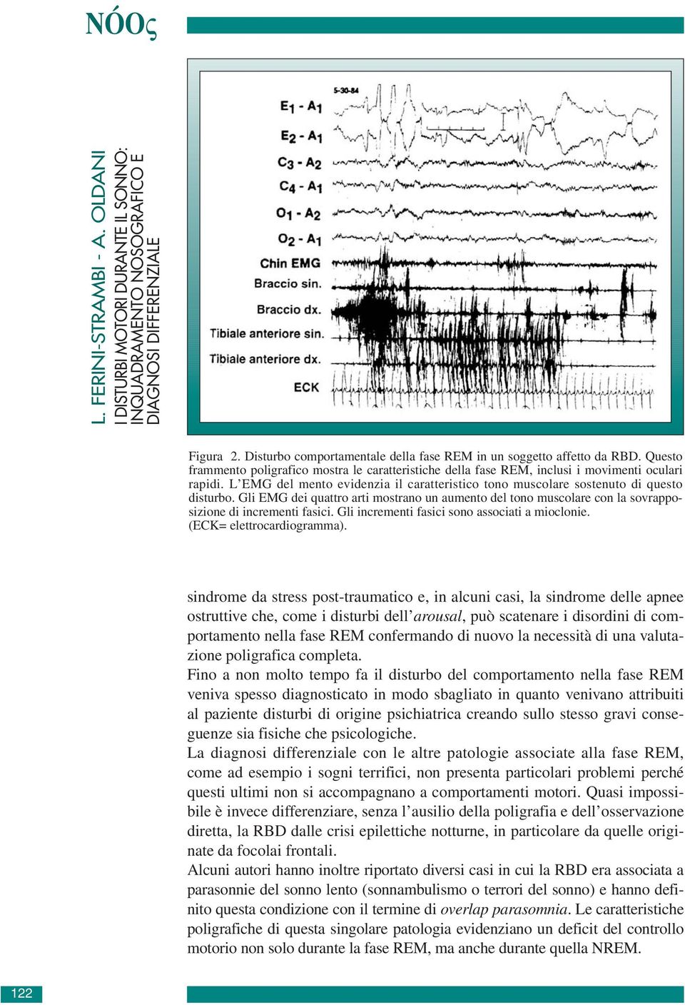 L EMG del mento evidenzia il caratteristico tono muscolare sostenuto di questo disturbo. Gli EMG dei quattro arti mostrano un aumento del tono muscolare con la sovrapposizione di incrementi fasici.