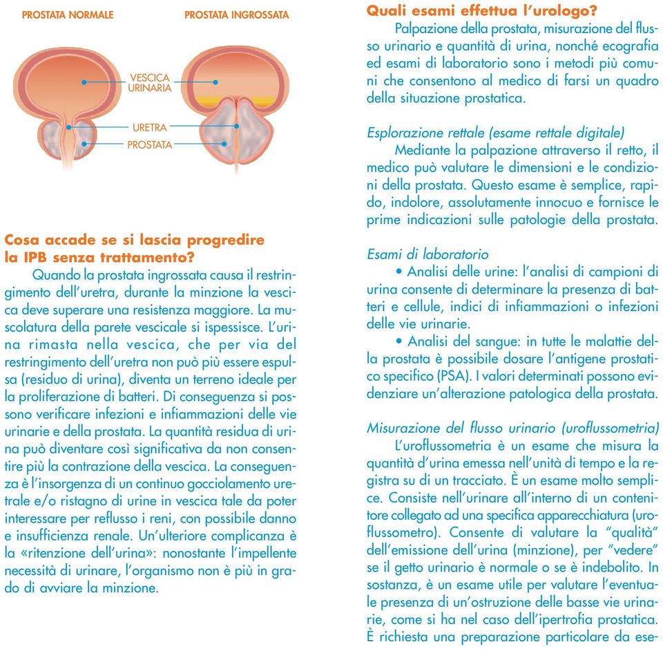 situazione prostatica. URETRA PROSTATA Cosa accade se si lascia progredire la IPB senza trattamento?