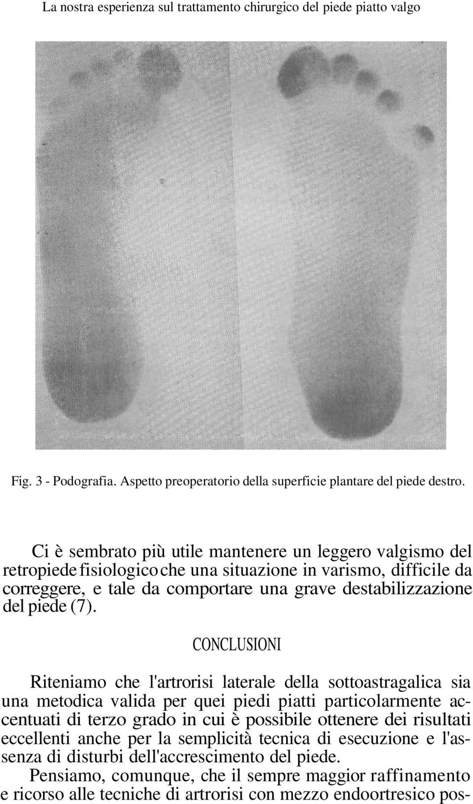 (7). CONCLUSIONI Riteniamo che l'artrorisi laterale della sottoastragalica sia una metodica valida per quei piedi piatti particolarmente accentuati di terzo grado in cui è possibile ottenere dei