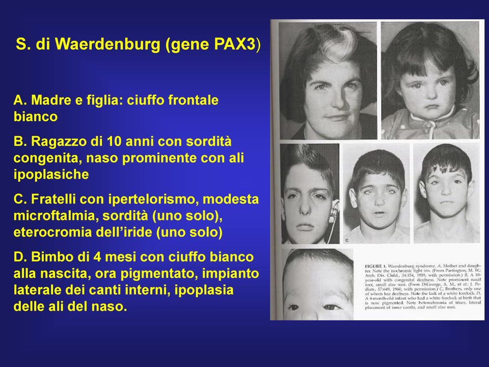 Fratelli con ipertelorismo, modesta microftalmia, sordità (uno solo), eterocromia dell iride (uno