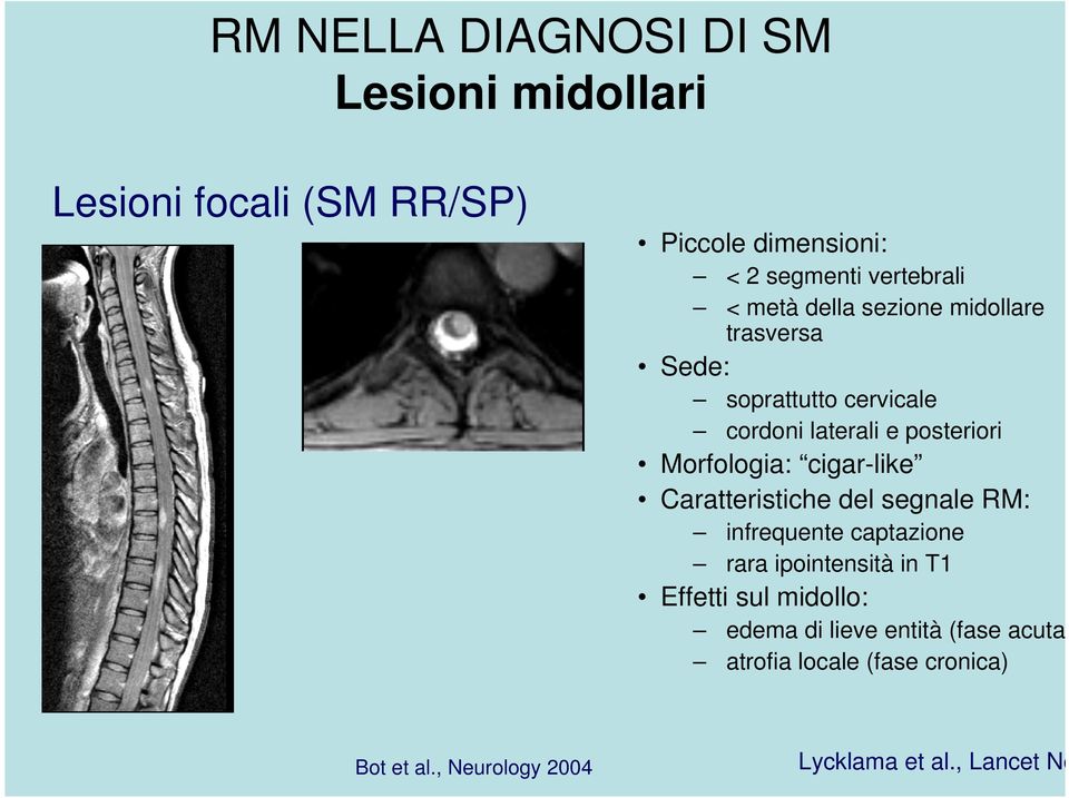 cigar-like Caratteristiche del segnale RM: infrequente captazione rara ipointensità in T1 Effetti sul midollo: