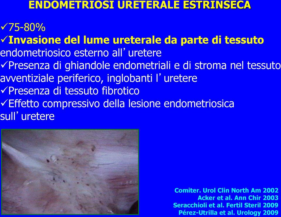 uretere Presenza di tessuto fibrotico Effetto compressivo della lesione endometriosica sull uretere Comiter.