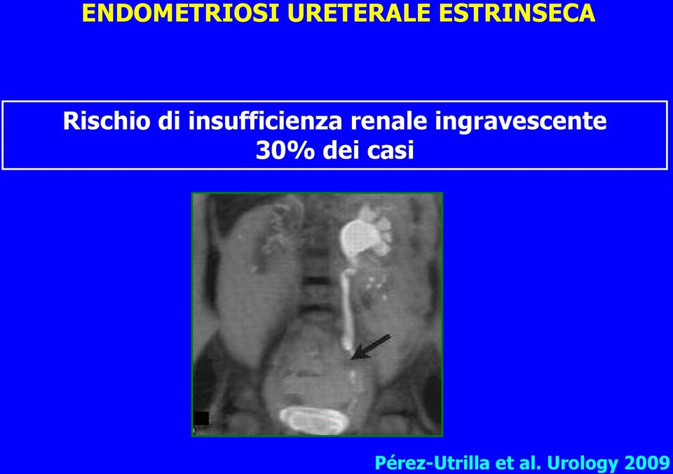 insufficienza renale