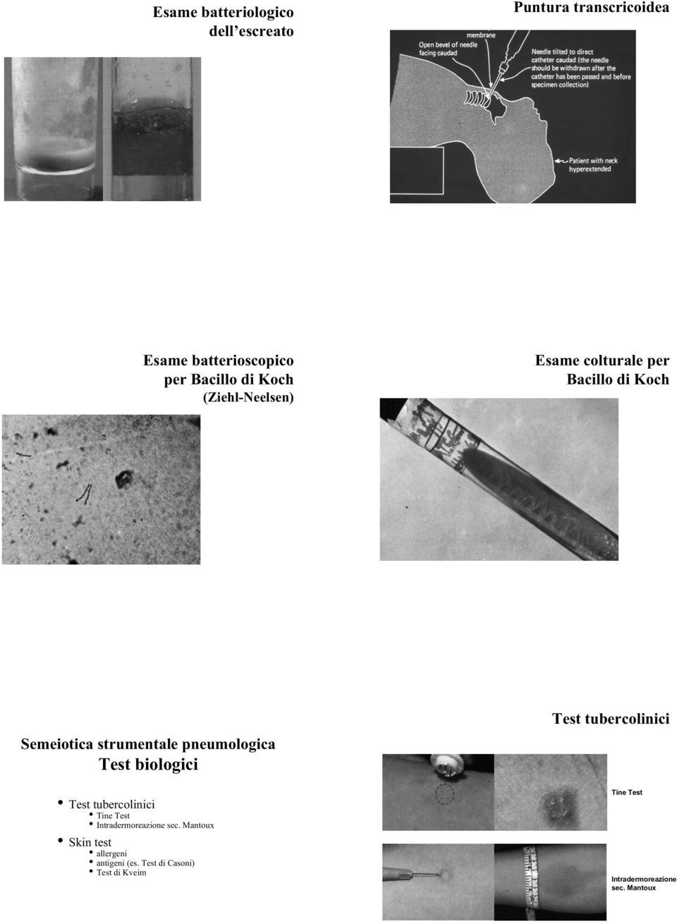 Test biologici Test tubercolinici Tine Test Intradermoreazione sec.