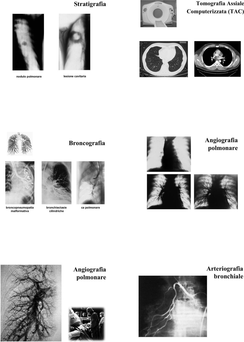 polmonare broncopneumopatia malformativa bronchiectasie