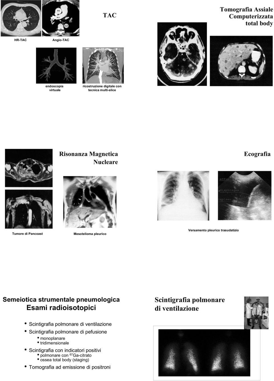 Esami radioisotopici Scintigrafia polmonare di ventilazione Scintigrafia polmonare di ventilazione Scintigrafia polmonare di pefusione