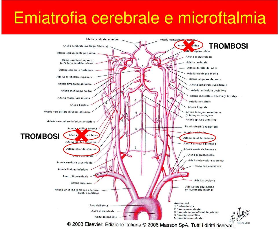 microftalmia