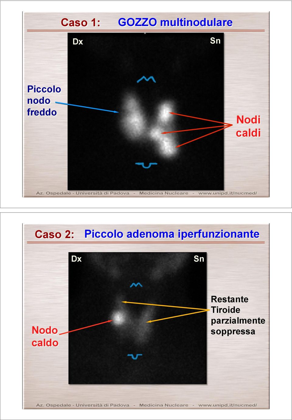 Dx Piccolo adenoma iperfunzionante Sn