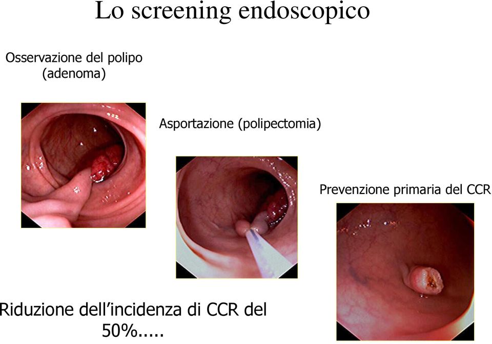 (polipectomia) Prevenzione primaria del