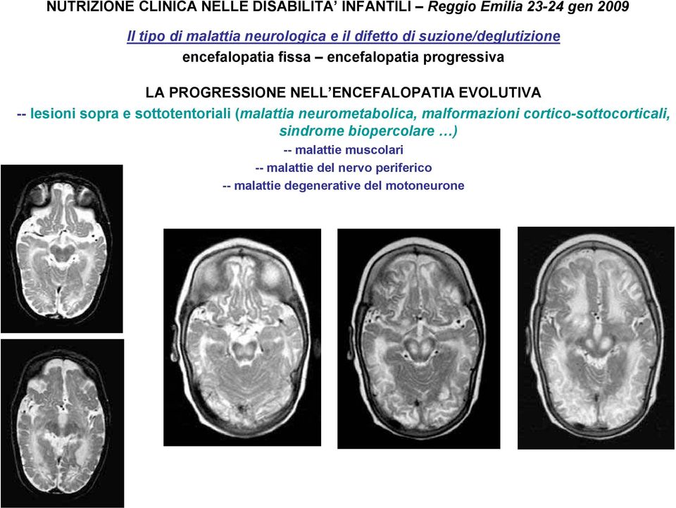 cortico-sottocorticali, sindrome biopercolare ) -- malattie