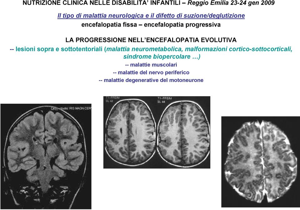 cortico-sottocorticali, sindrome biopercolare ) -- malattie