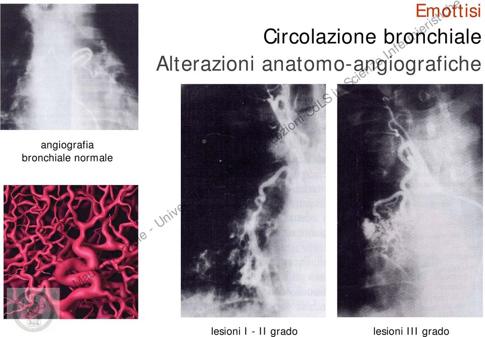 Alterazioni anatomo-angiografiche