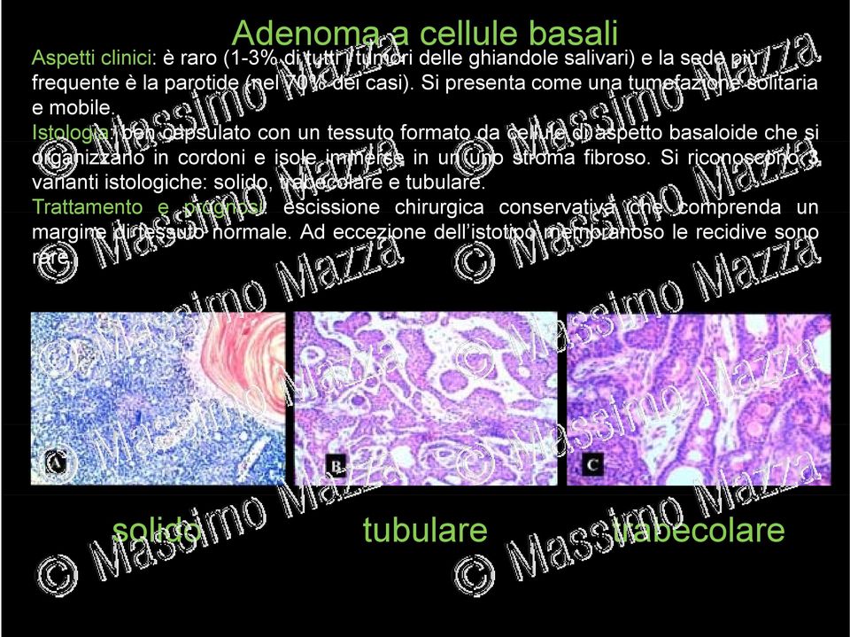 Istologia: bencapsulato con un tessuto formato da cellule di aspetto basaloide che si organizzano in cordoni e isole immerse in un uno stroma fibroso.