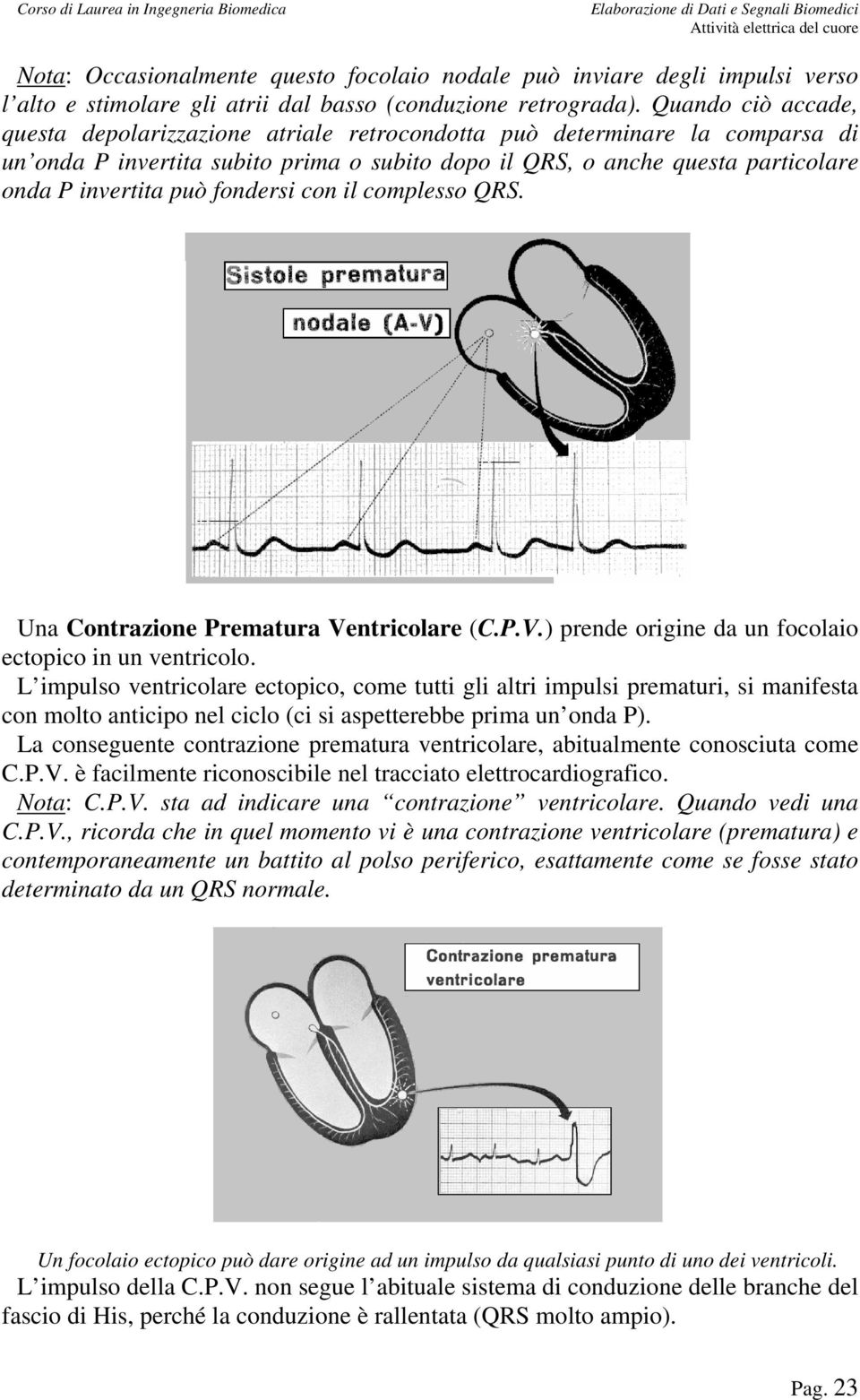 fondersi con il complesso QRS. Una Contrazione Prematura Ventricolare (C.P.V.) prende origine da un focolaio ectopico in un ventricolo.