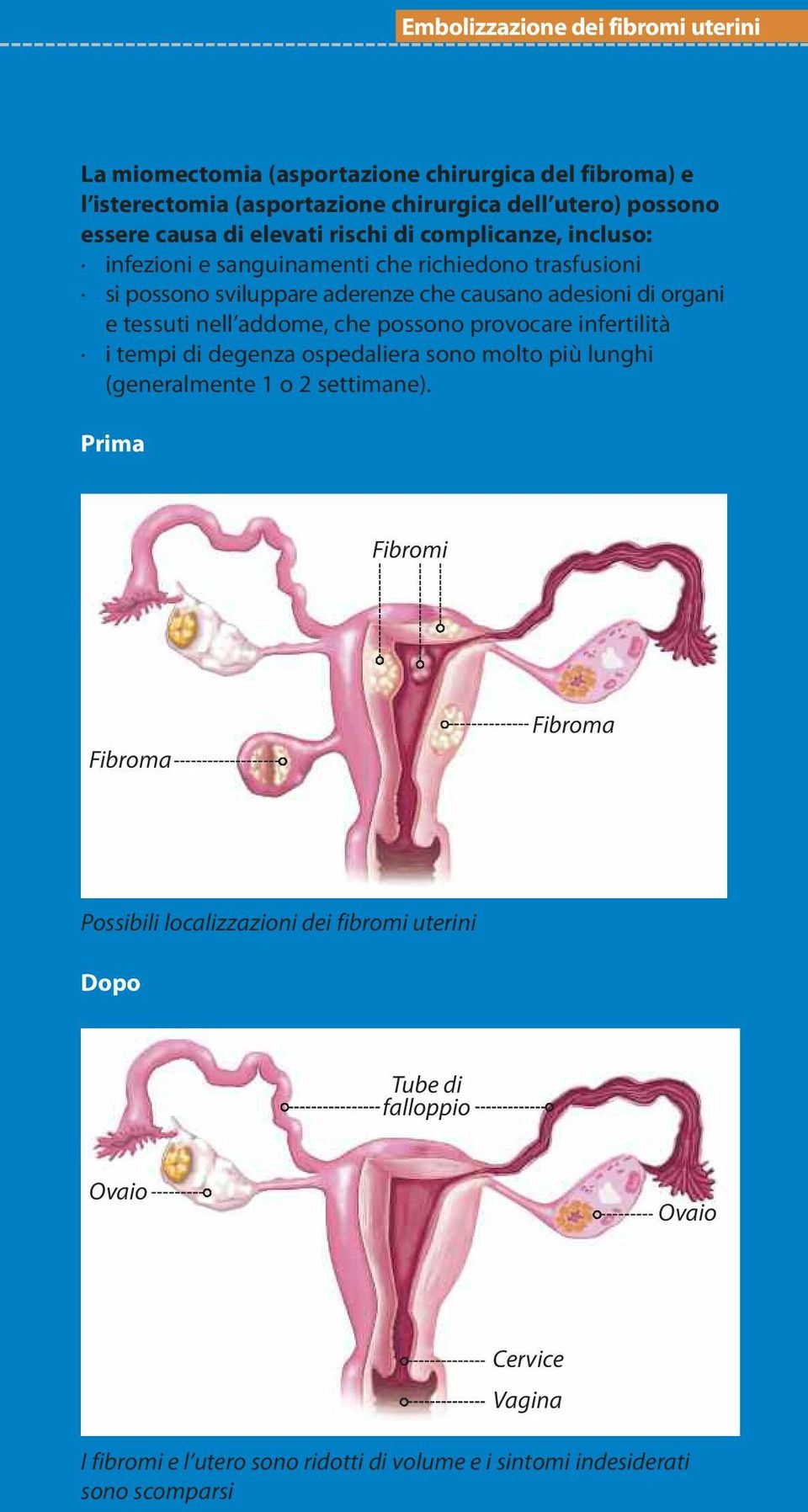 nell addome, che possono provocare infertilità i tempi di degenza ospedaliera sono molto più lunghi (generalmente 1 o 2 settimane).