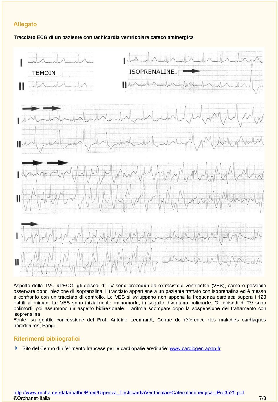 Le VES si sviluppano non appena la frequenza cardiaca supera i 120 battiti al minuto. Le VES sono inizialmente monomorfe, in seguito diventano polimorfe.