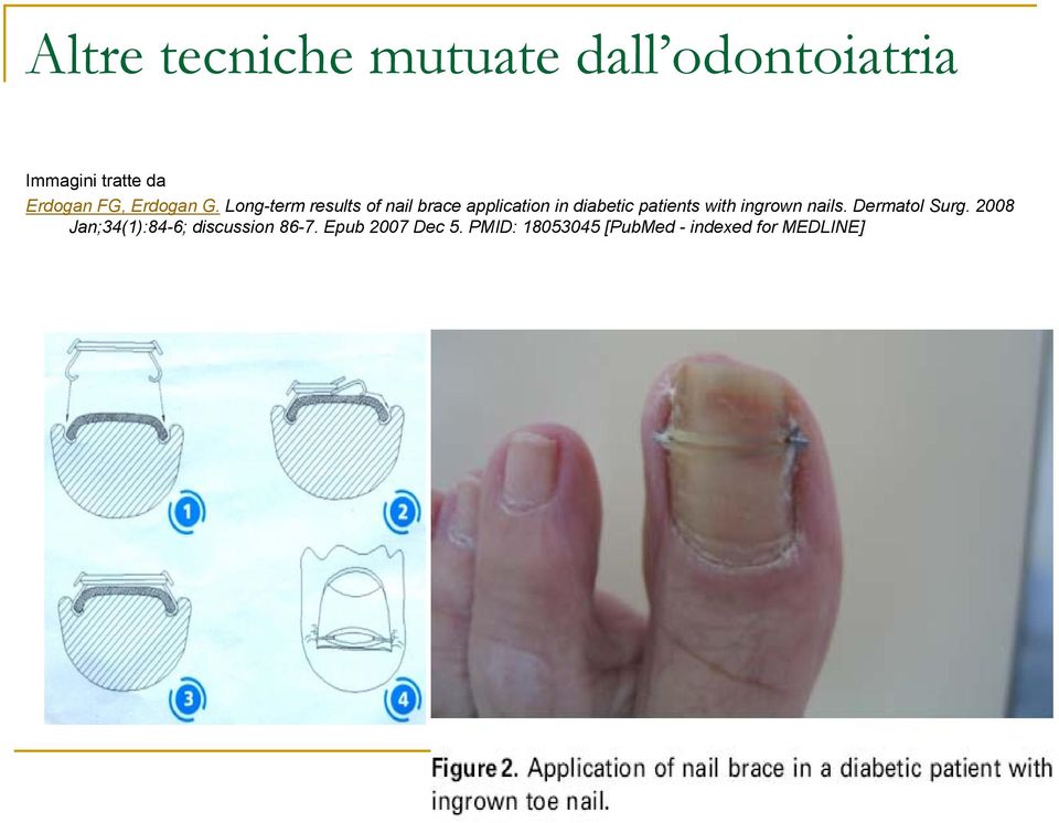 Long-term results of nail brace application in diabetic patients with