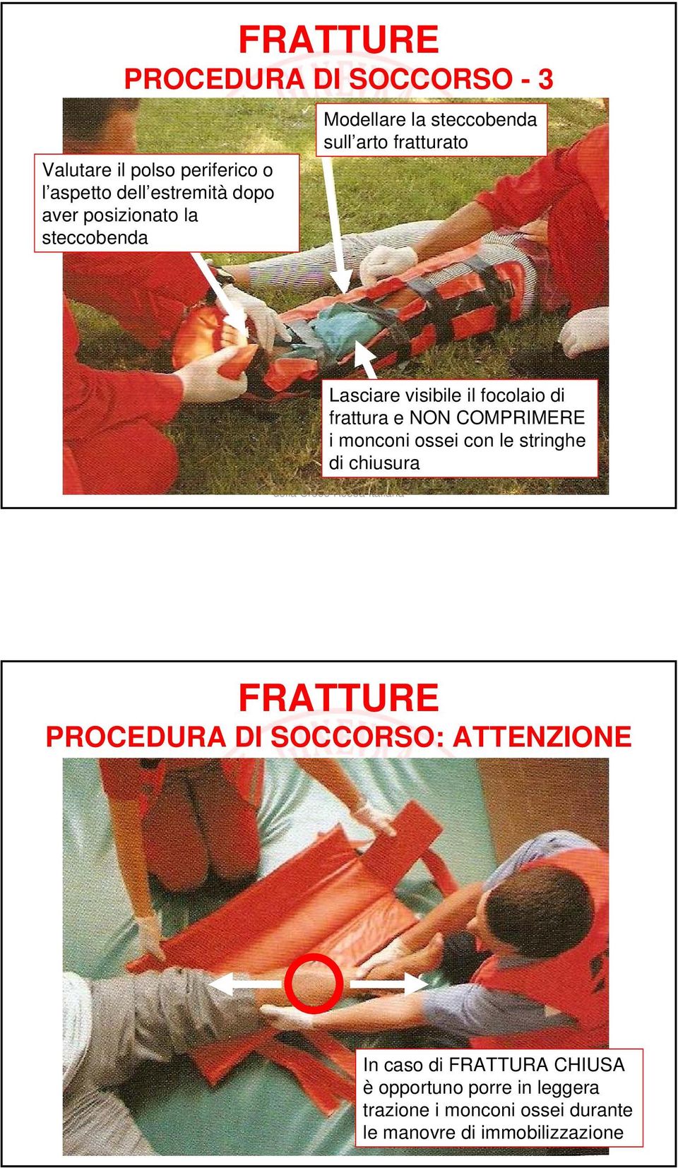 frattura e NON COMPRIMERE i monconi ossei con le stringhe di chiusura FRATTURE PROCEDURA DI SOCCORSO: