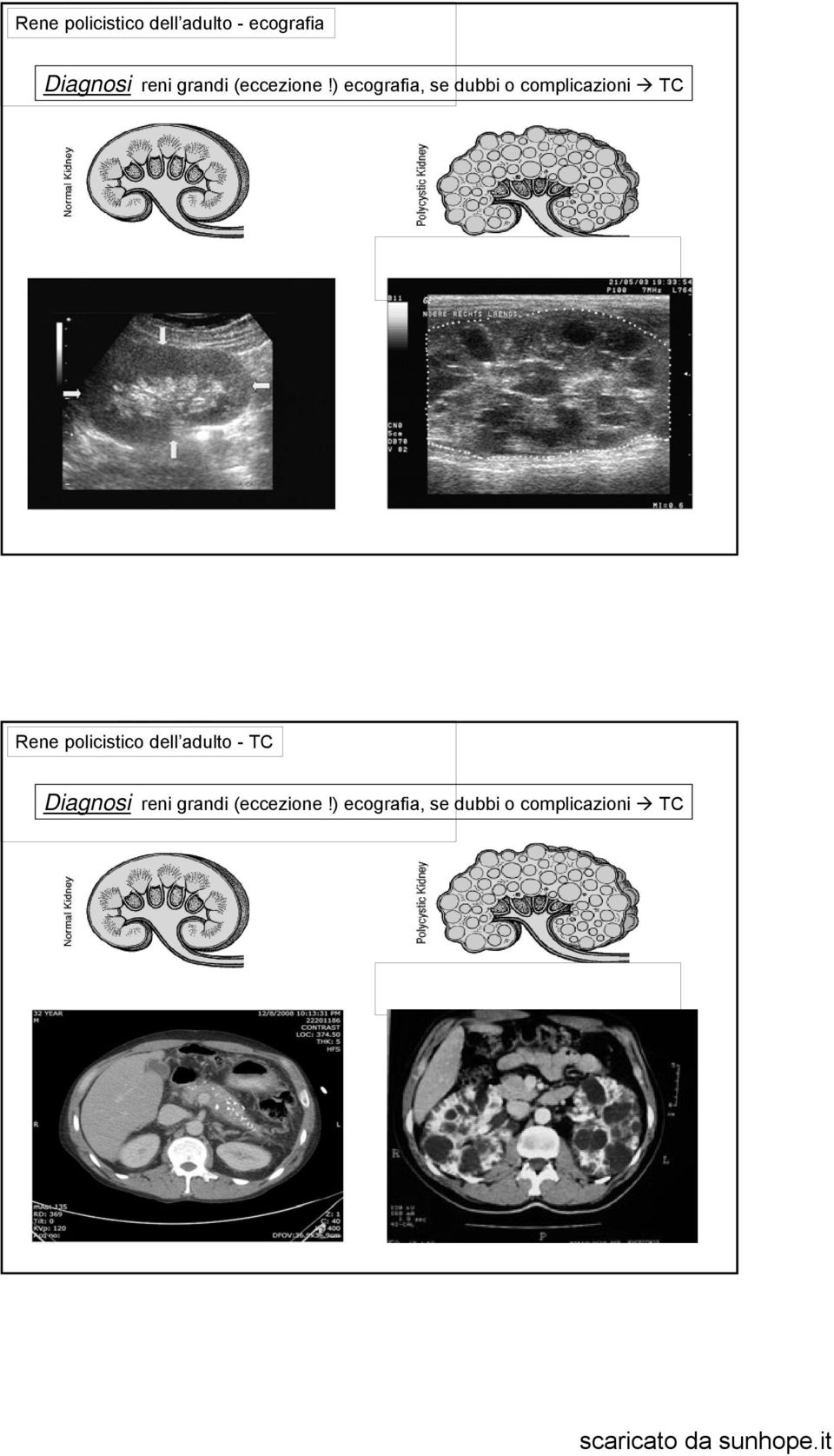 ) ecografia, se dubbi o complicazioni TC Rene