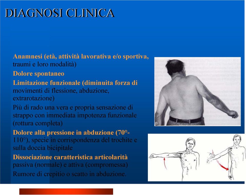immediata impotenza funzionale (rottura completa) Dolore alla pressione in abduzione (70-110 ), specie in corrispondenza del trochite e