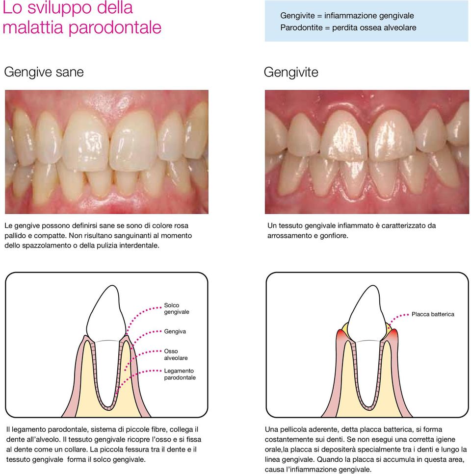Solco gengivale Placca batterica Gengiva Osso alveolare Legamento parodontale Il legamento parodontale, sistema di piccole fibre, collega il dente all alveolo.