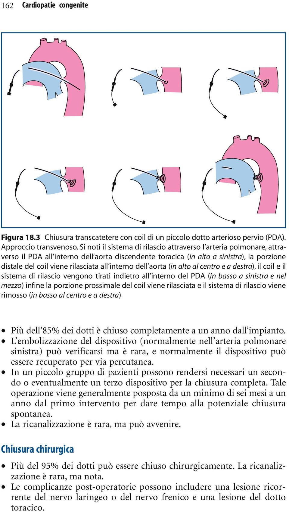 interno dell aorta (in alto al centro e a destra), il coil e il sistema di rilascio vengono tirati indietro all interno del PDA (in basso a sinistra e nel mezzo) infine la porzione prossimale del