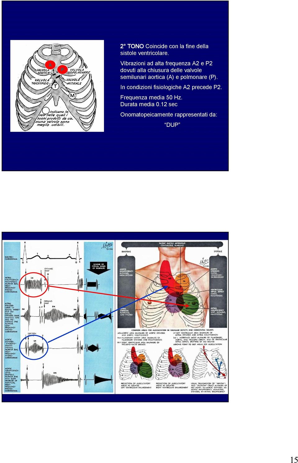 semilunari aortica (A) e polmonare (P).