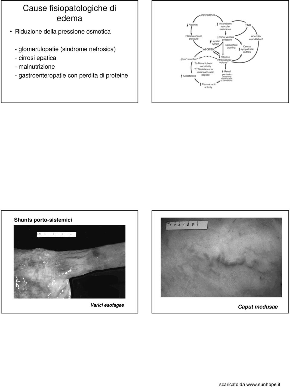 epatica - malnutrizione - gastroenteropatie con perdita di